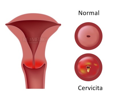 Cervicita